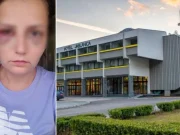 Pretučena radnica hotela ‘Jablanica’ za jablanicalive.com: Brutalno me tukao po glavi, imam prelome