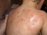 U Konjicu 10 osoba oboljelo od morbila